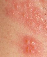 Herpes i skeden symptomer