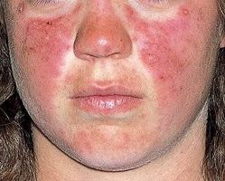 Lupus symptomer hud