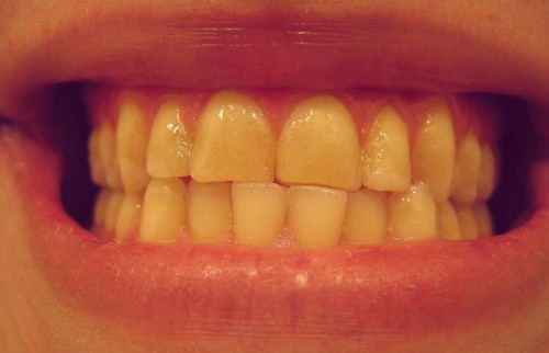 Tegn på periodontal sykdom