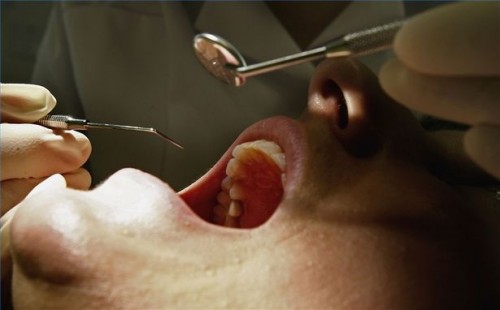 Hvordan erstatte en tann Fylling Midlertidig