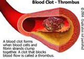 Hvordan forebygge og behandle Blodpropper