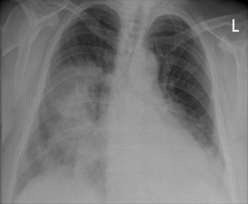 Årsaker til en Spot på Lung