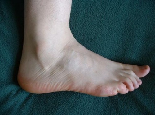 Hva er behandlingen for Numb Feet i diabetes?