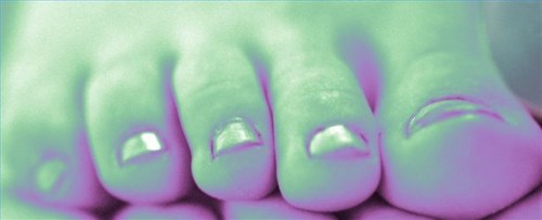 Hvordan behandle Charcot Foot