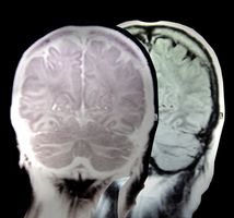 Neuro Intervensjons Radiologist Fakta