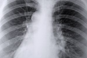 Lunge Bulløst Disease