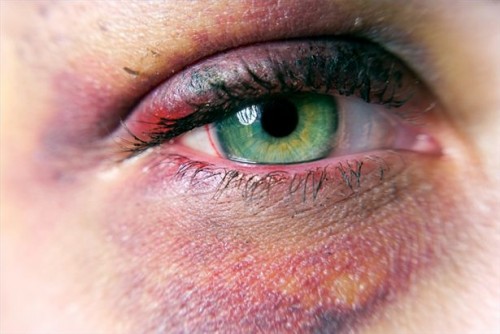 Hvordan behandle en Black Eye (blåmerke)