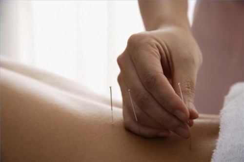 Hvordan bruke akupunktur for å behandle et sår