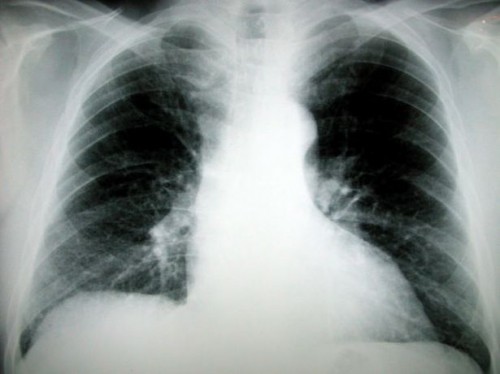 Revmatoid Artritt lungesykdom