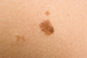 Hva er de brune flekker på huden som du kan skrape av?