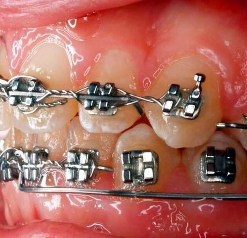 Historien om tannregulering