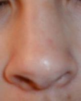 Hva fører til en kronisk tett nese?