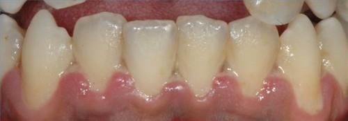 Urter for periodontal sykdom