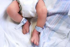 Hva er behandlingen for klumpføtter hos nyfødte?