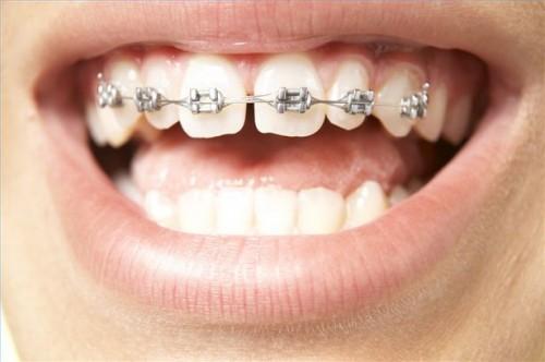 Hvordan å takle tannregulering som tenåring