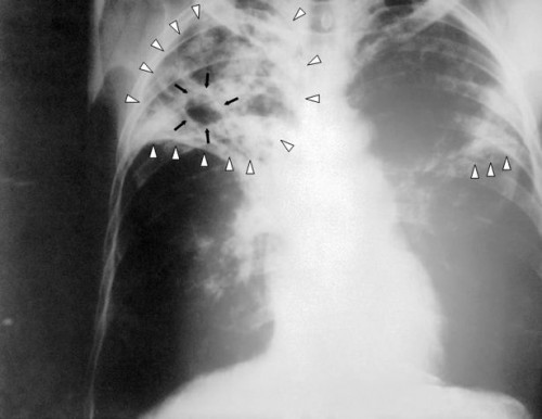 Hvordan er TB overførbare?