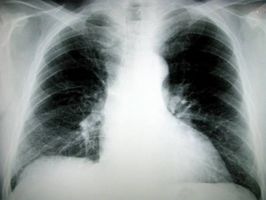 Hva er symptomene på Dust lungebetennelse?