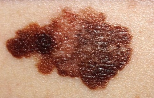 Typer av malignt melanom