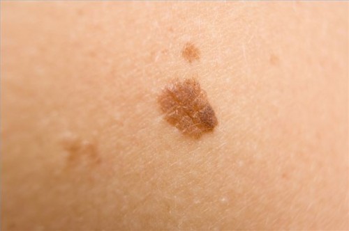 Hvordan behandle melanom