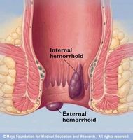 hemorroider og Anal Sex