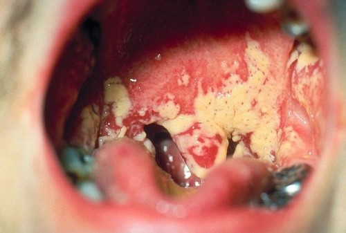 Oral Thrush Behandling