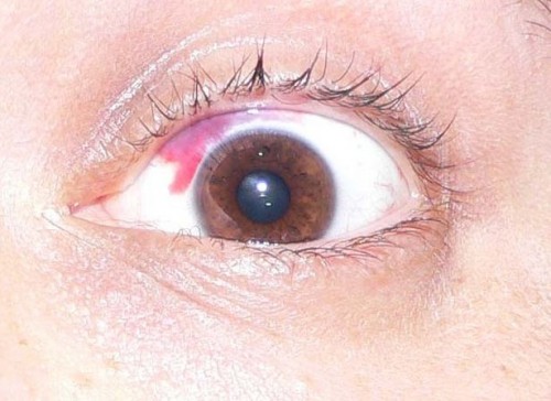 Hva er årsaken til ødelagte blodkar i øynene?