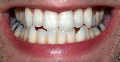 Hvordan Clean & sterilisere Dental Instruments
