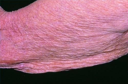 Hva er årsakene til Tynning hud?