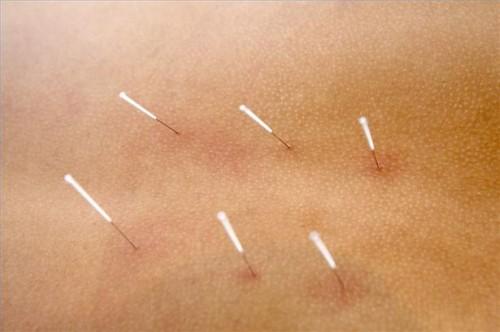Hvordan å behandle forkjølelsessår Med Akupunktur