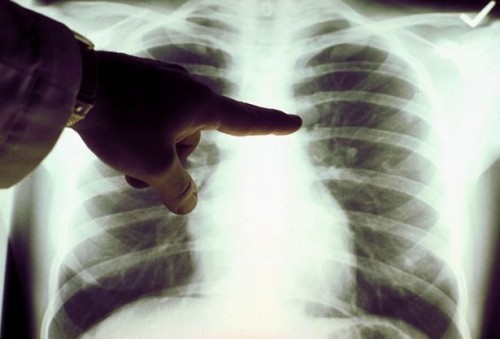 Hvordan gjenkjenne Tidlige symptomer på lungekreft