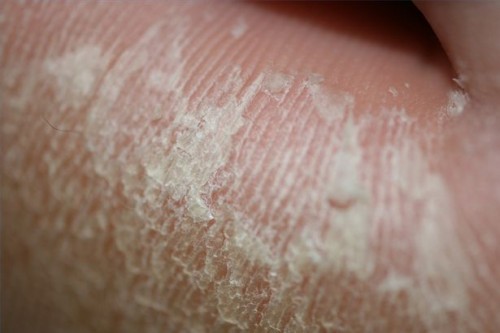 Podiatrist Callus Behandling og Skin Removal