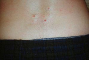 Hva er behandlingen for Sweat Utslett Flekker på ryggen?